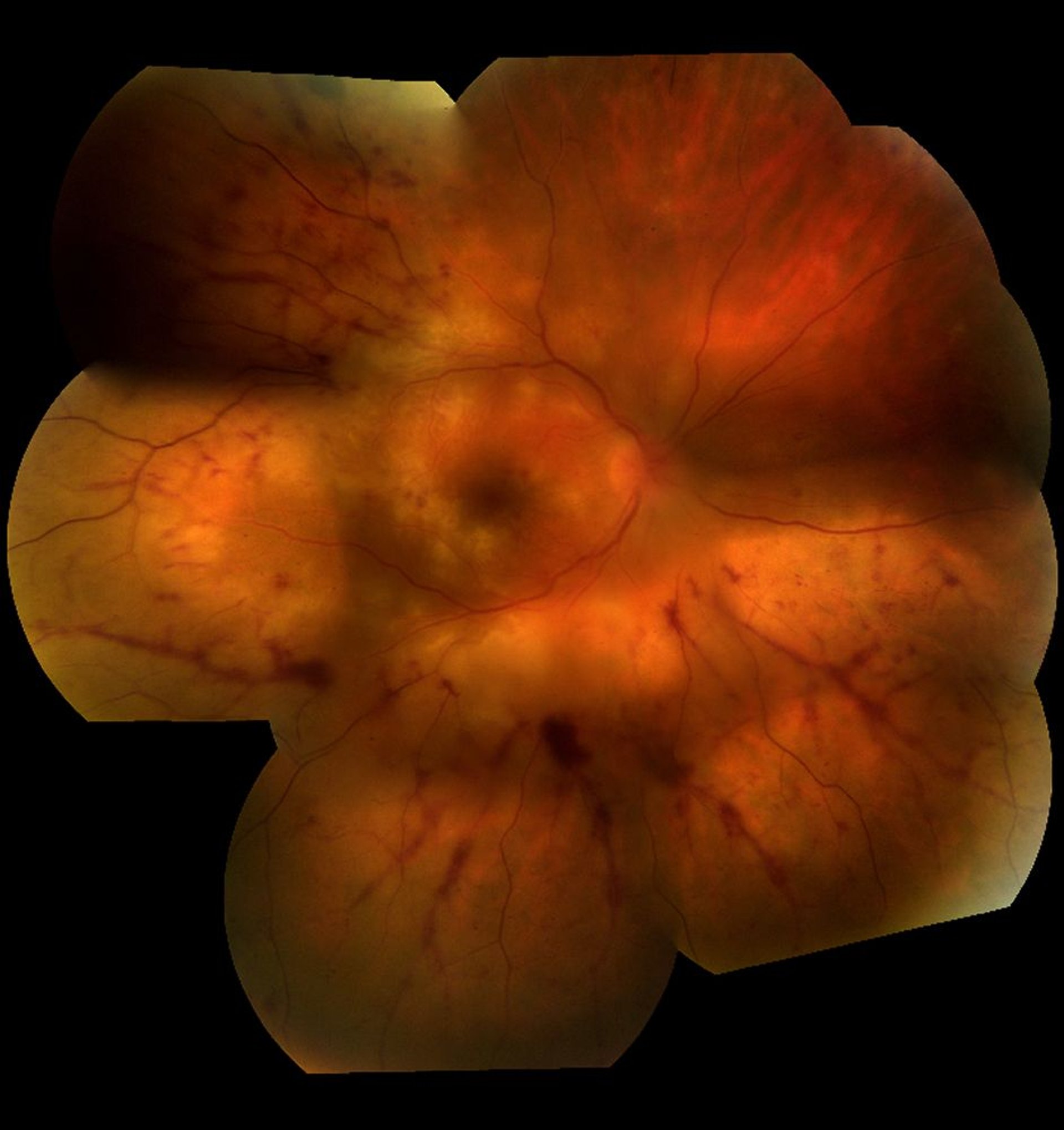 Retinitis (HSV)