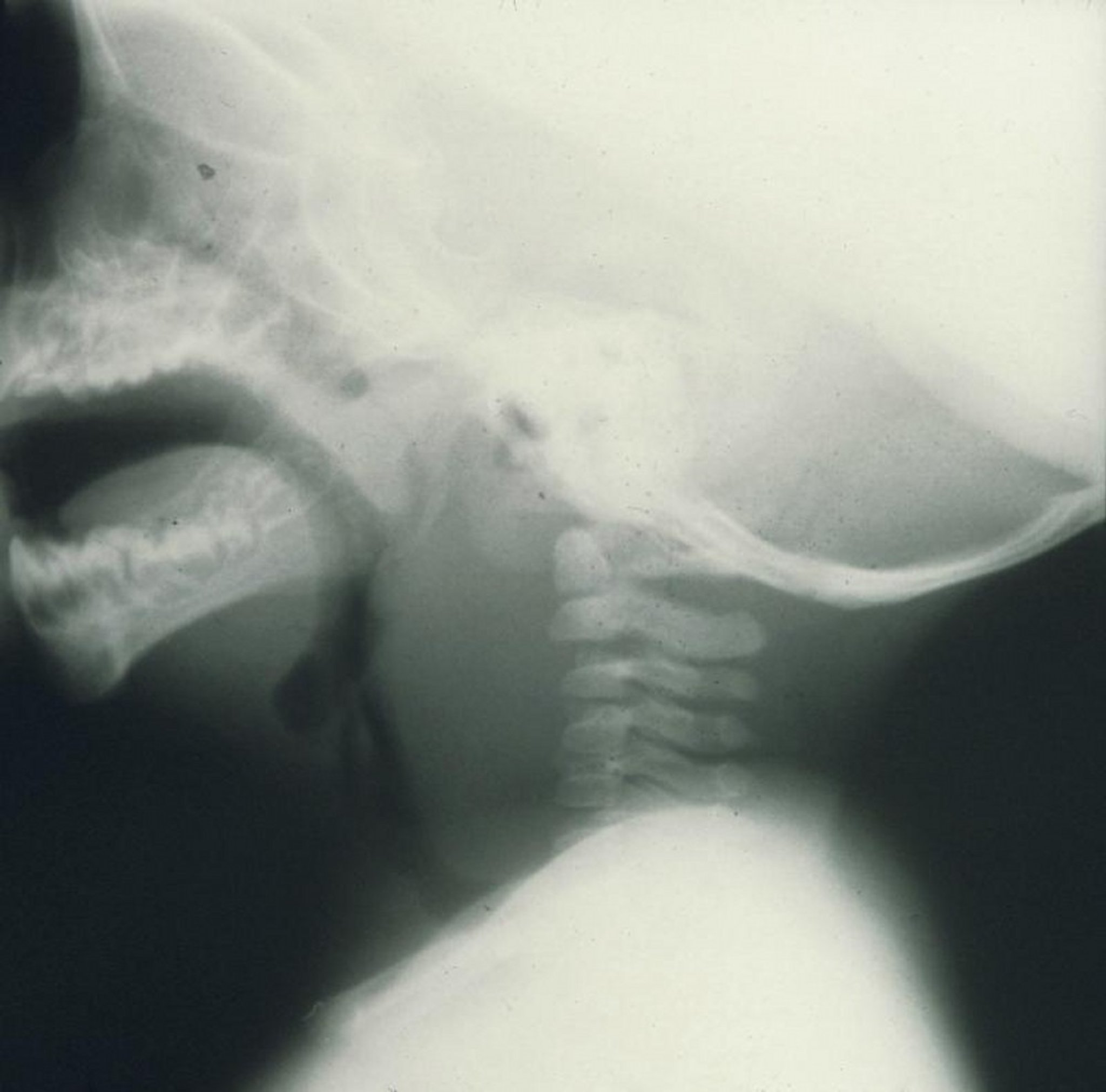 Retropharyngeal Abscess