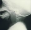 Abcès rétropharyngés
