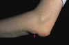 Rheumatoid Nodules (Ulna)
