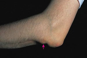 Nódulos reumatoides (cúbito)