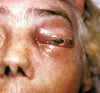 Nhiễm Mucormycosis mũi não