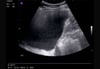Lateral Thoracic Ultrasound (Right)