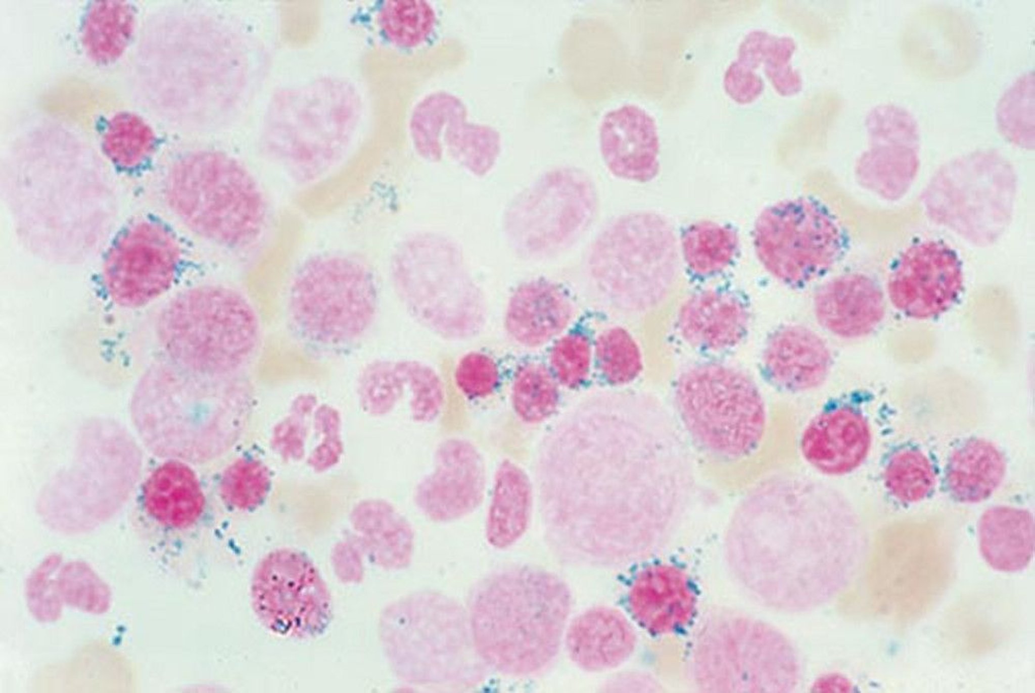 Ring Sideroblasts in Sideroblastic Anemia