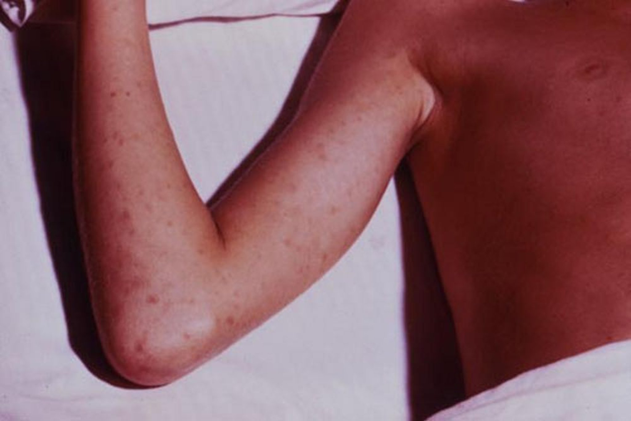 Rocky Mountain Spotted Fever
