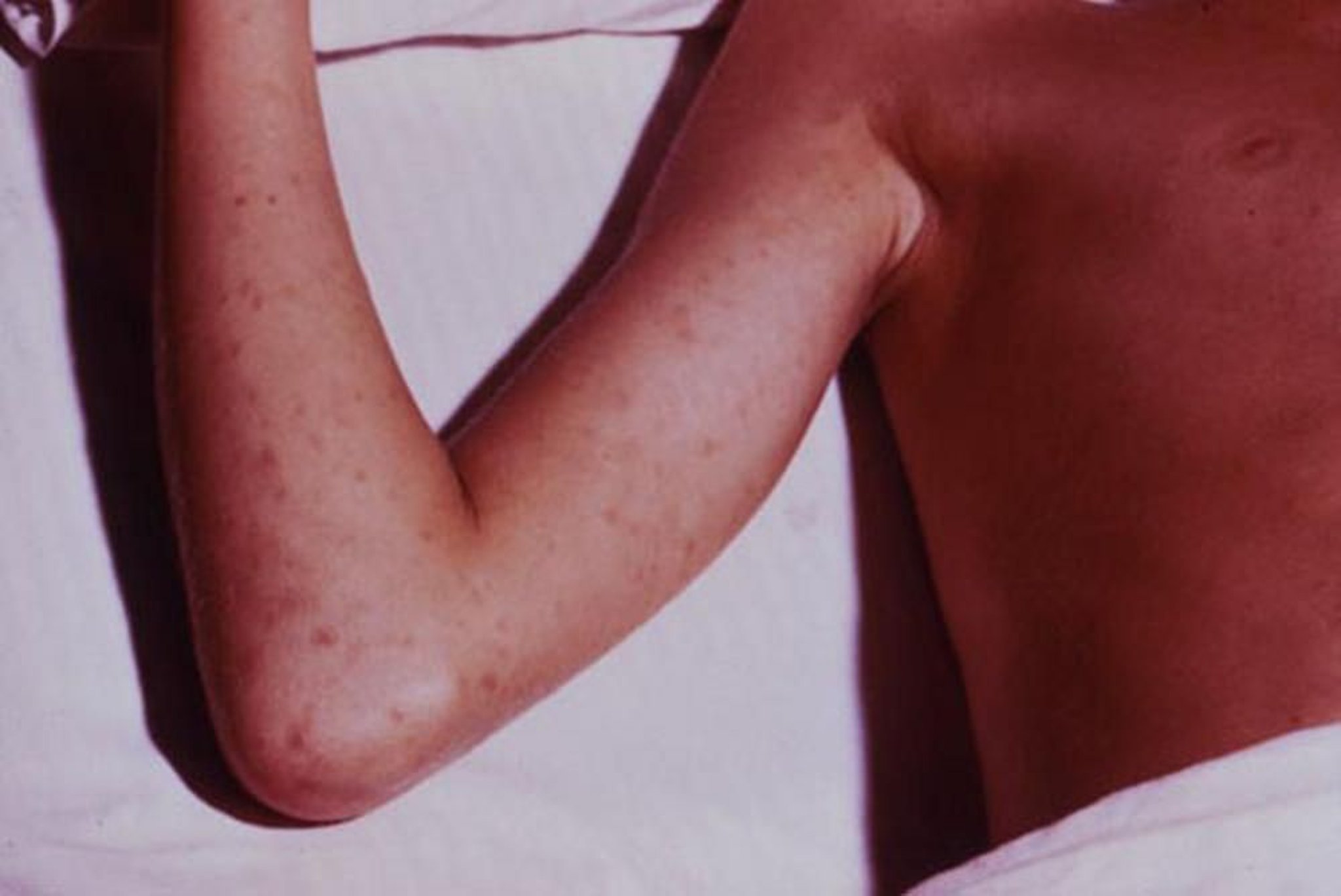 Плямиста гарячка Скелястих Гір