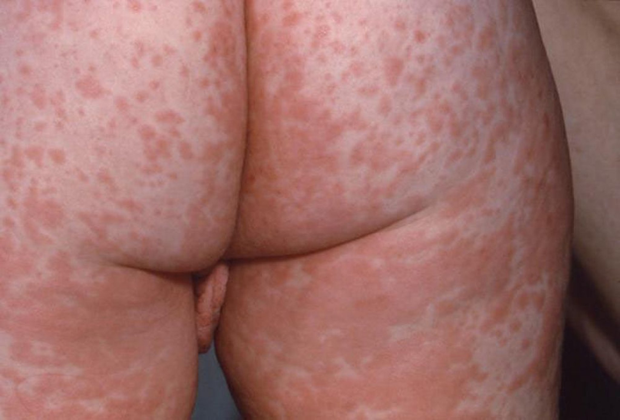 Eruzione maculopapulare nel morbillo (1)