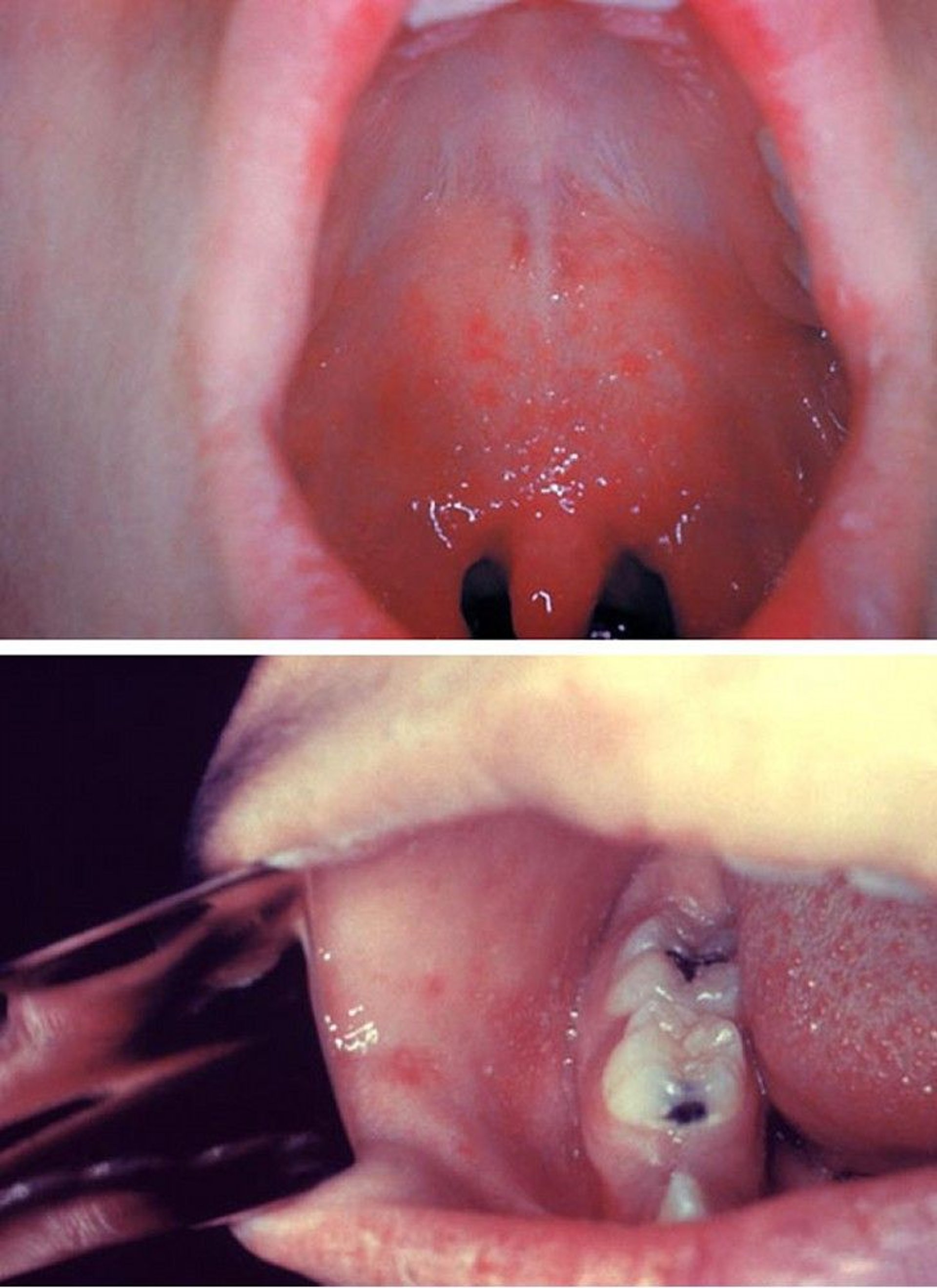 Measles (Koplik Spots)