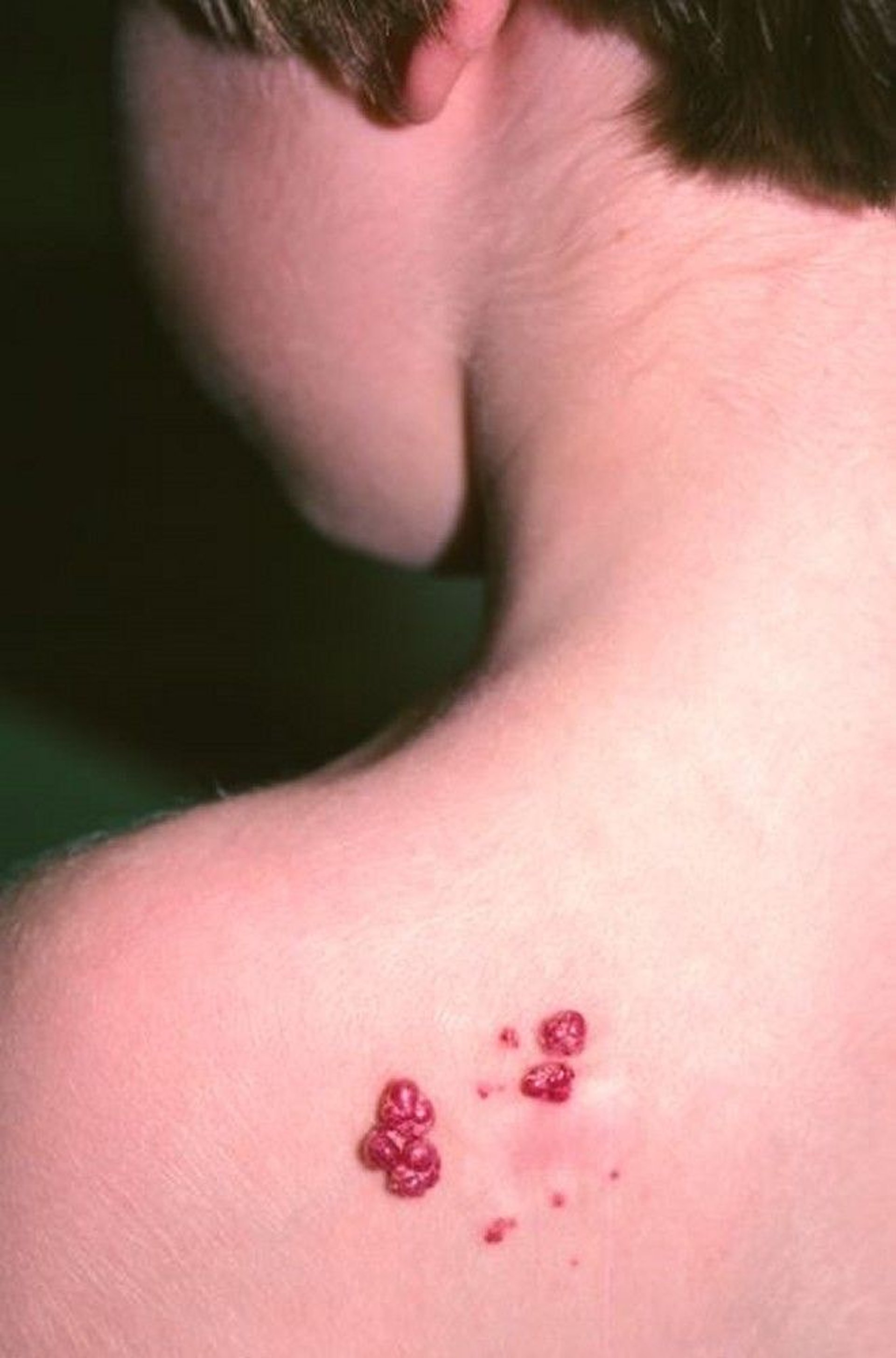 化膿性肉芽腫（肩）