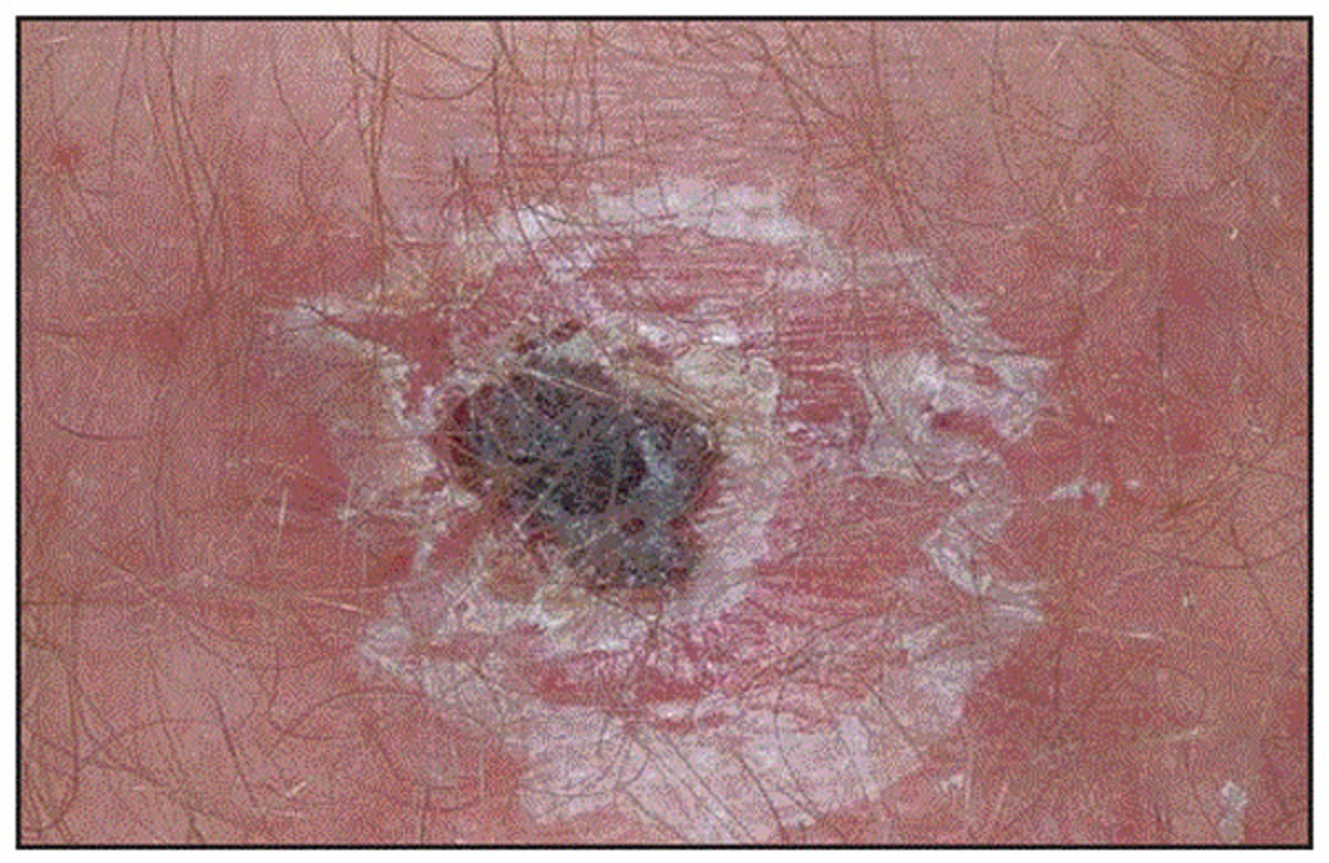 <i >Rickettsia parkeri</i> Rickettsiosis (Eschar)