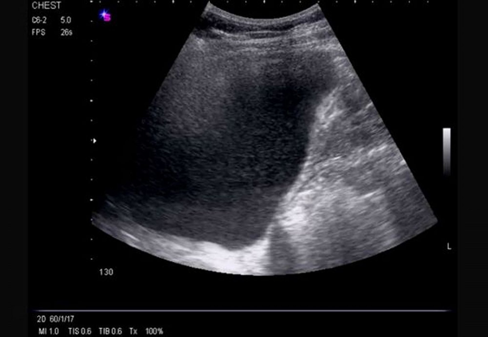 Lateraler Thoraxultraschall (rechts)