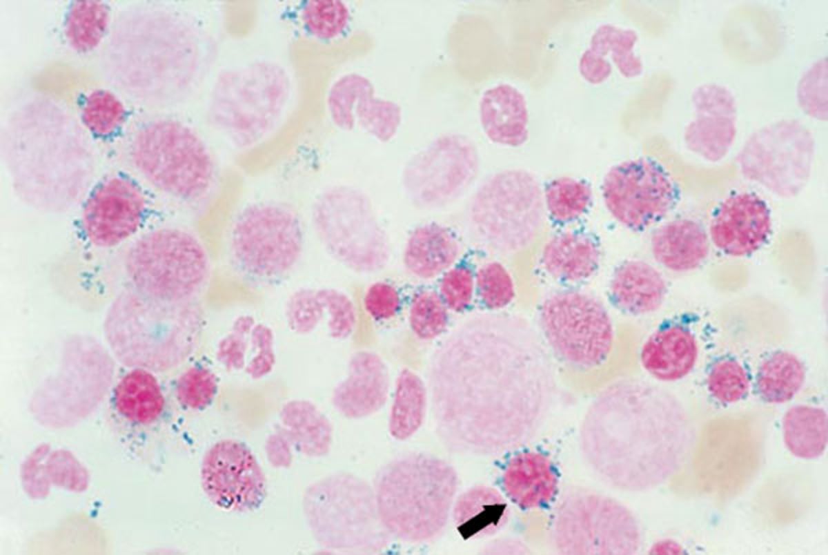 Ring Sideroblasts in Sideroblastic Anemia