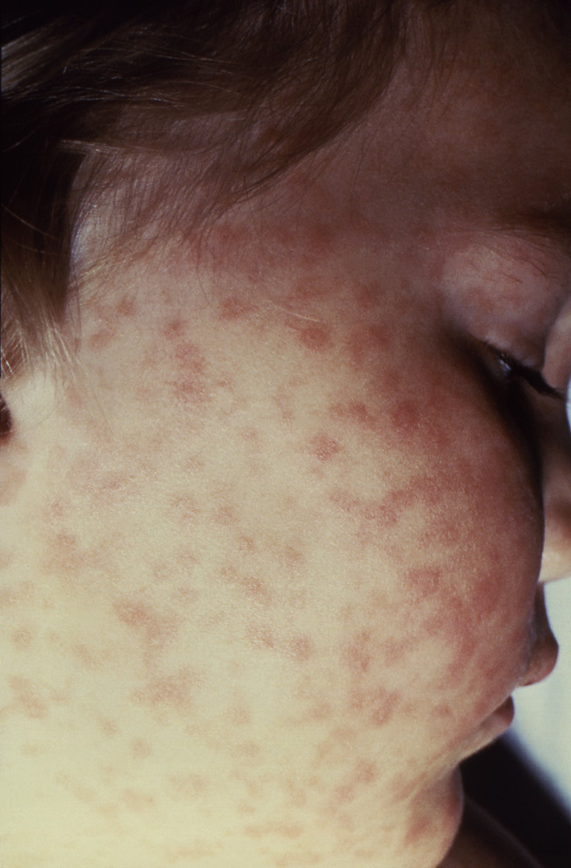 Rocky Mountain Spotted Fever Rash (2)