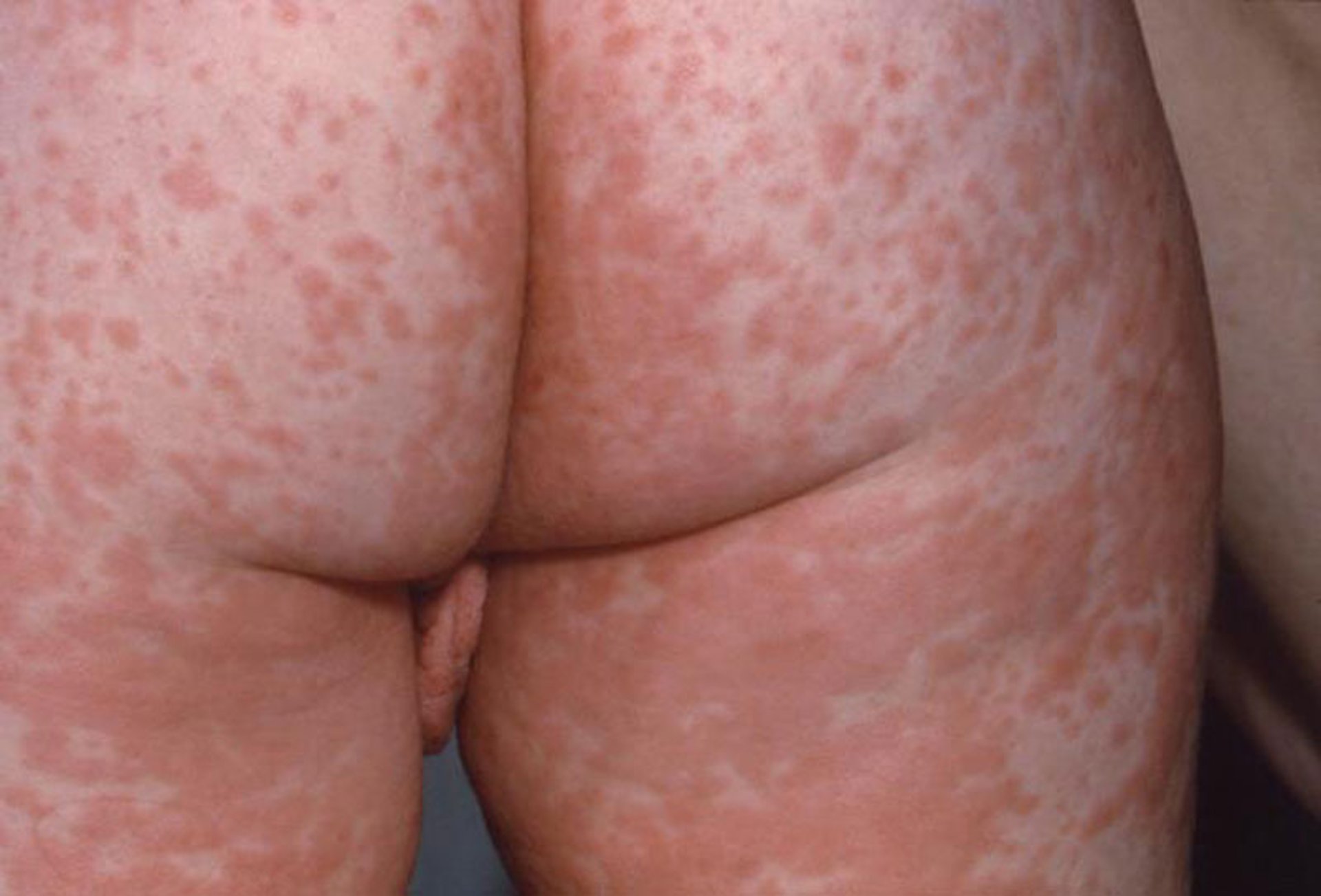 Maculopapular Rash in Measles (1)
