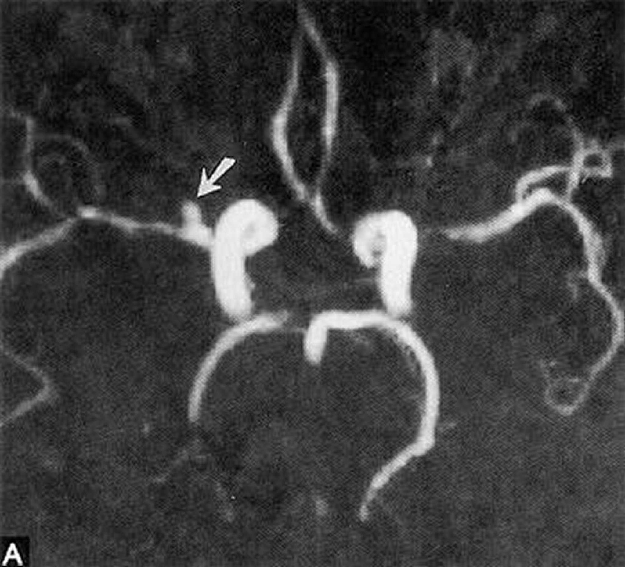 Sackförmiges Aneurysma
