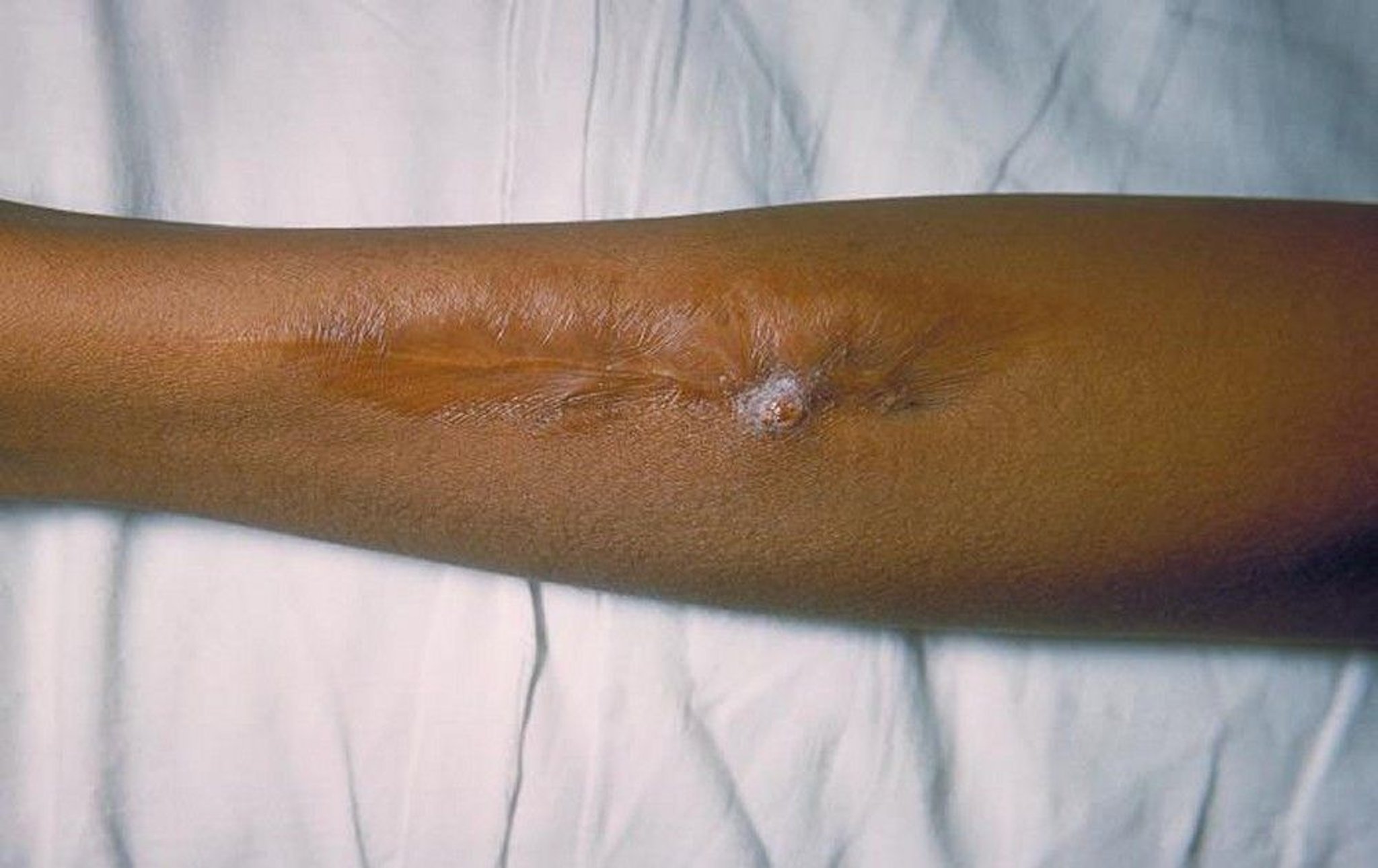 Salmonella (Skin Lesion)