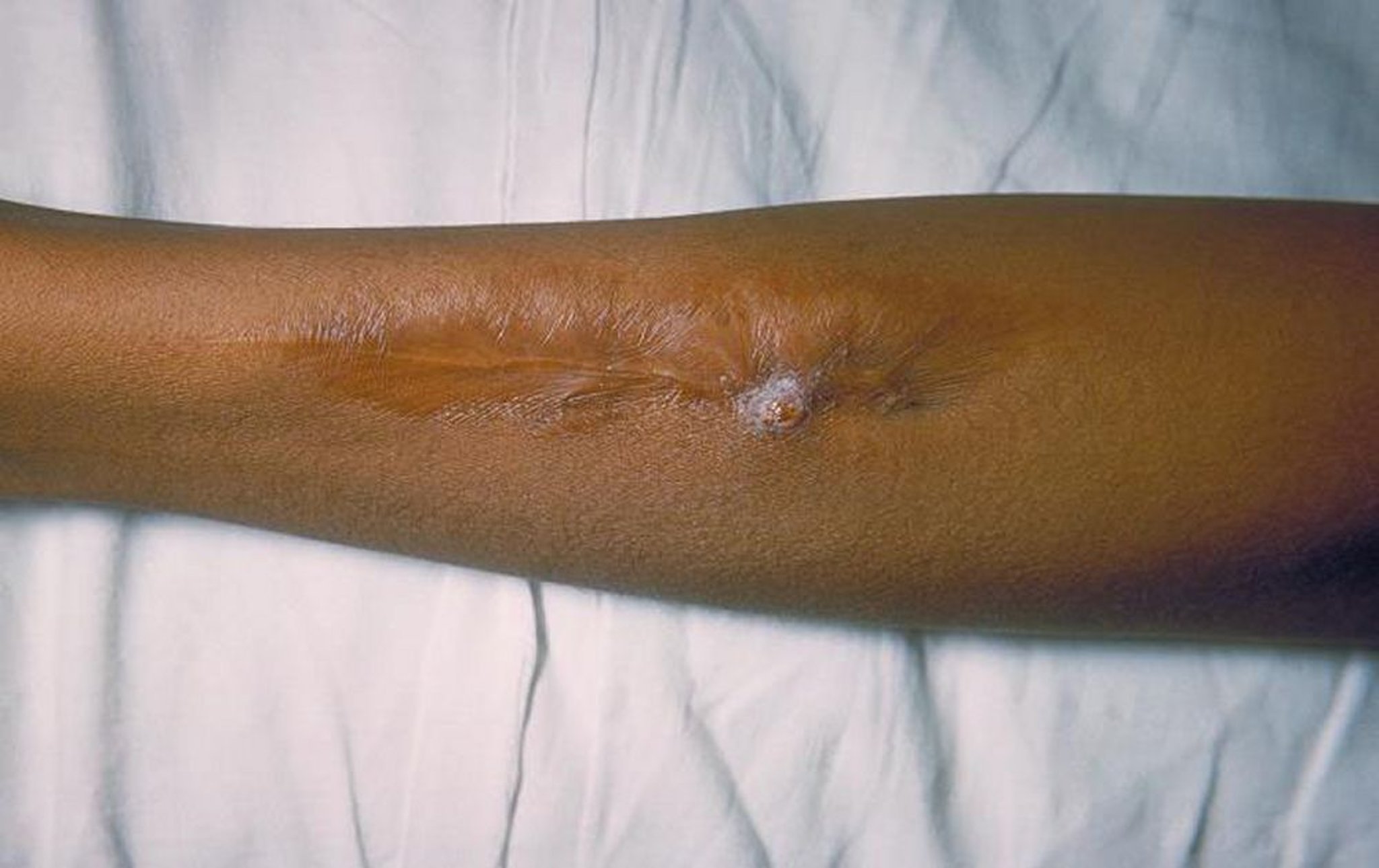 Salmonelosis (lesión cutánea)