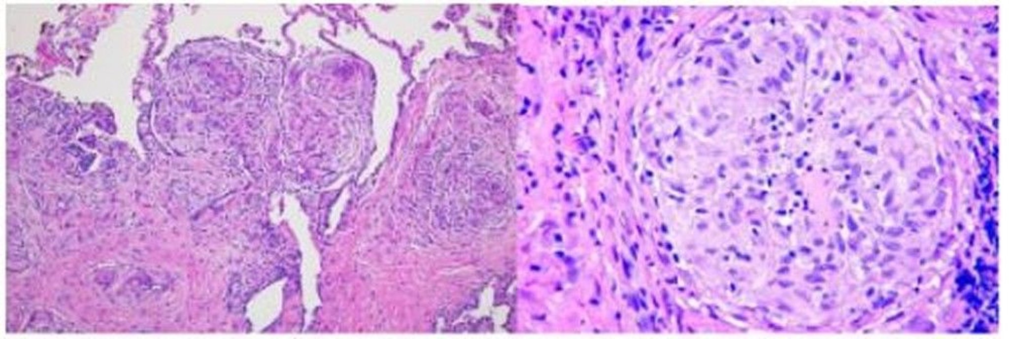 Sarcoidosis (Histopathology)