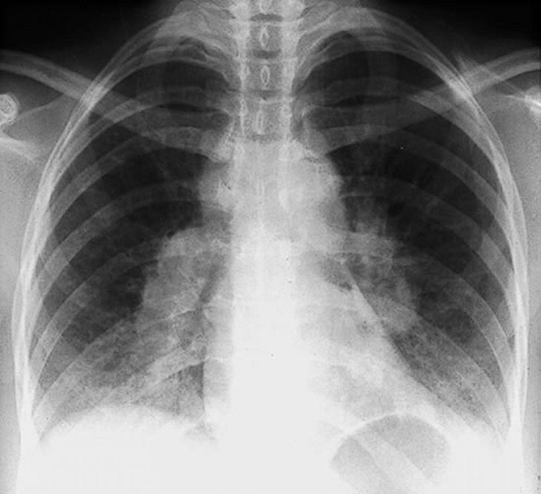 Sarcoidosis (Stage I)