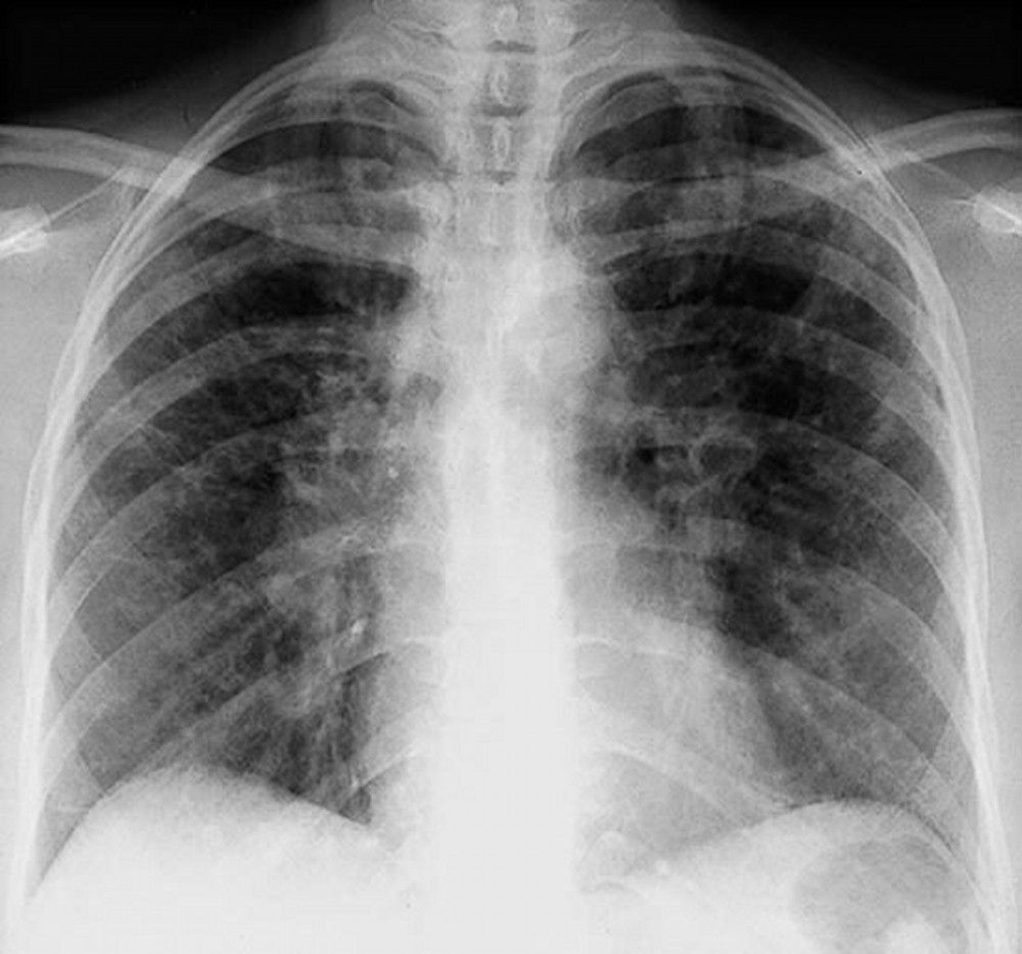 Sarcoidosis (Stage II)