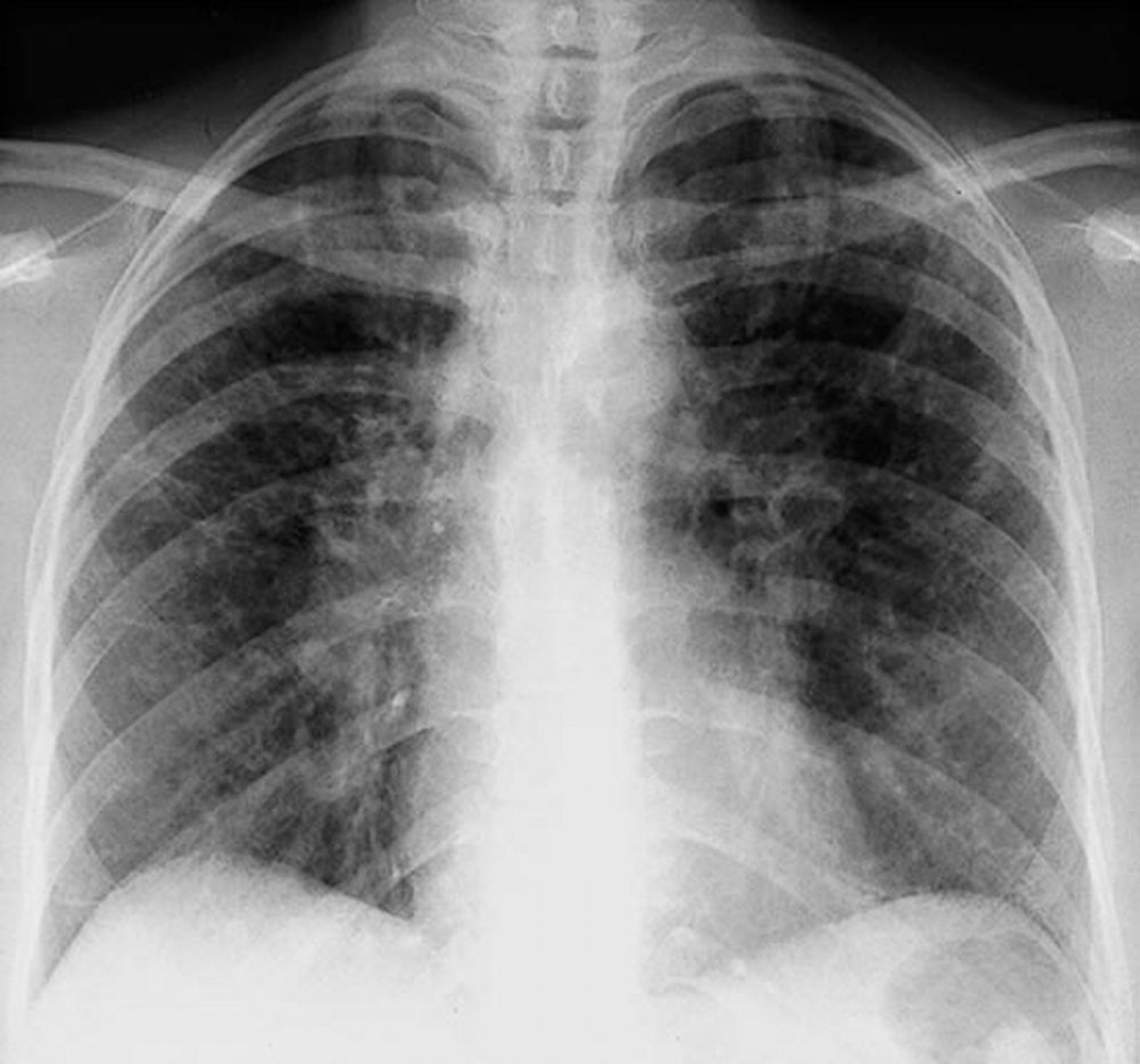 Sarcoidosis (estadio II)