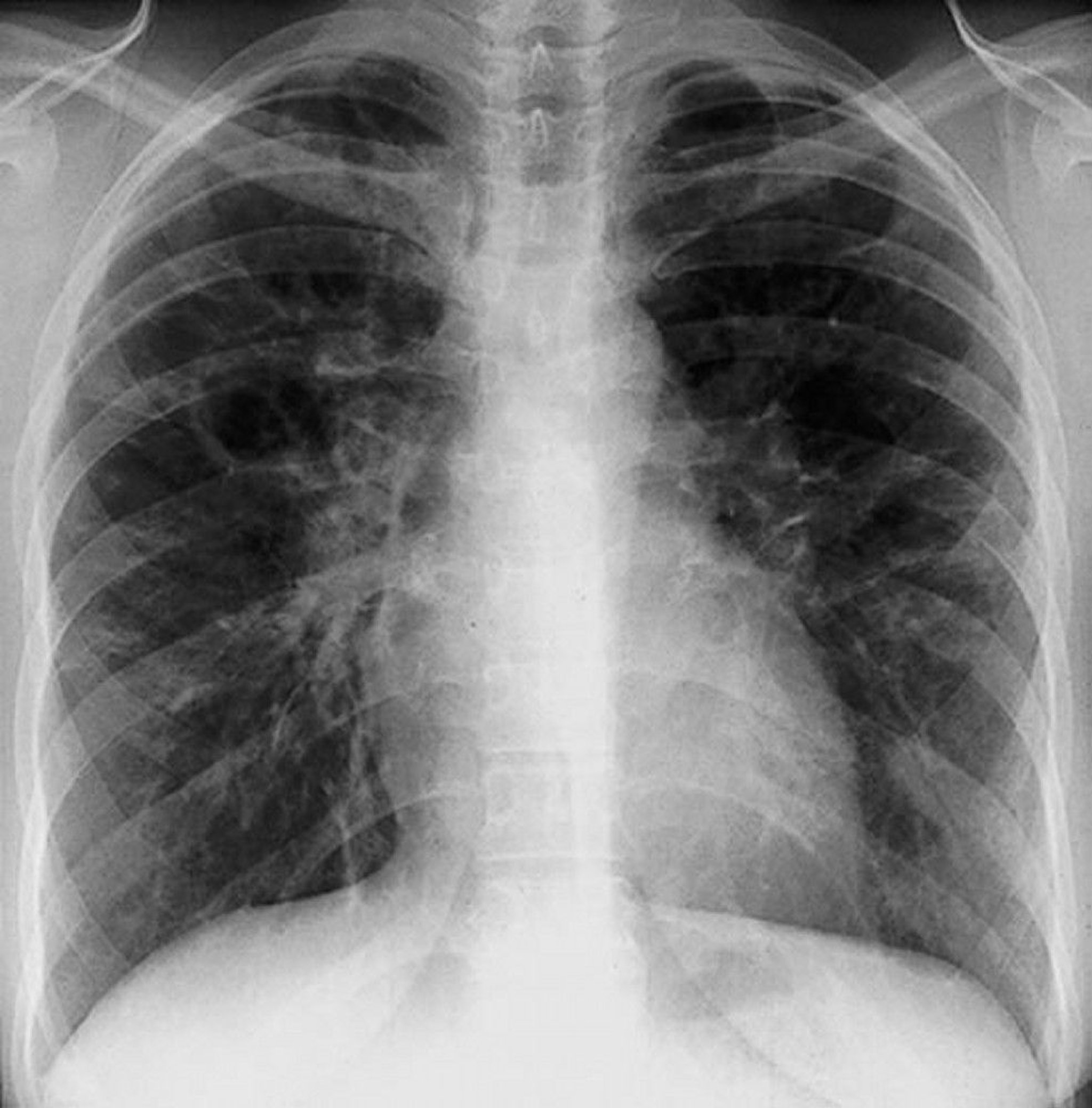 Sarcoidosis (Stage III)