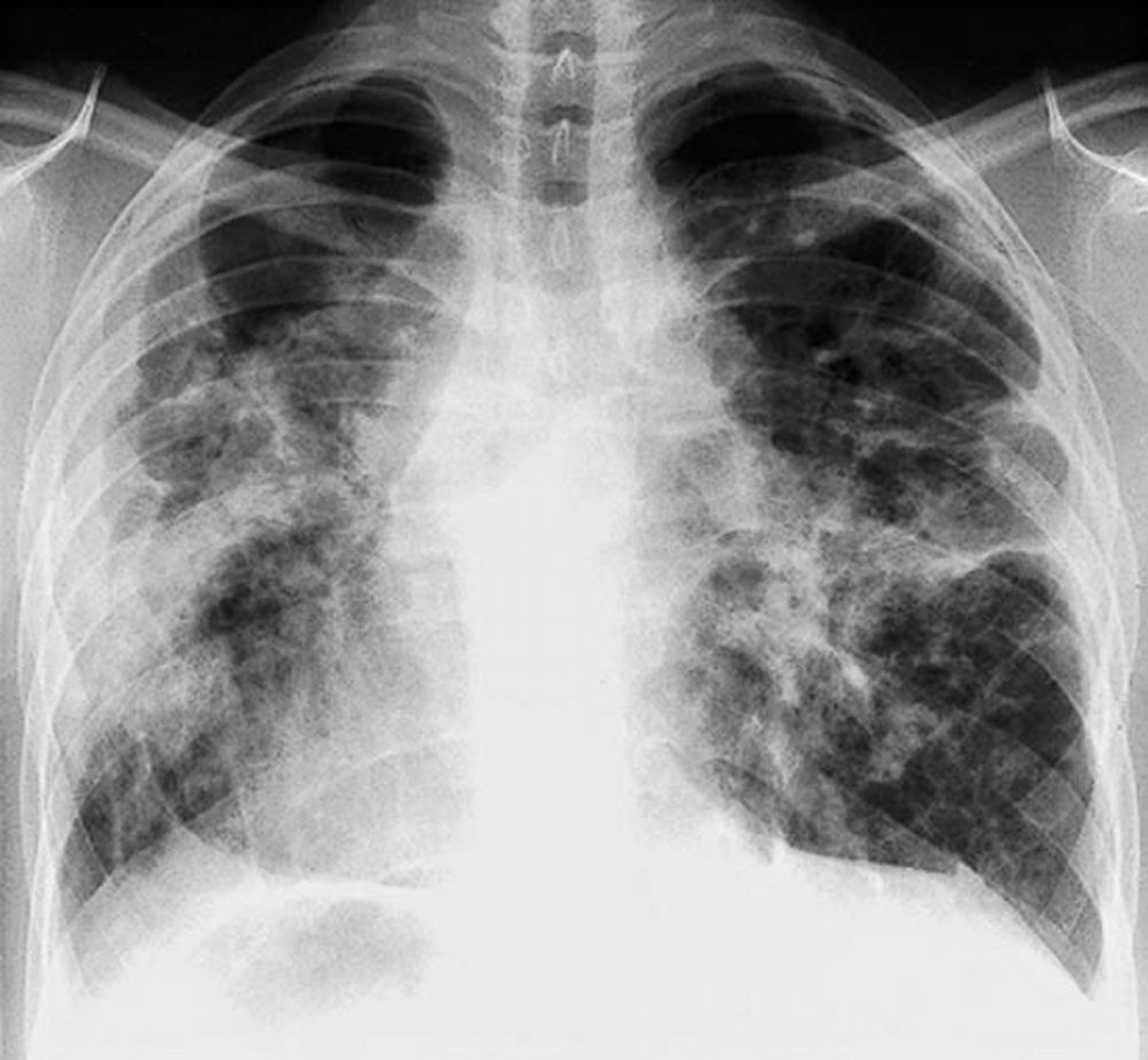 Sarcoidosis (estadio IV)