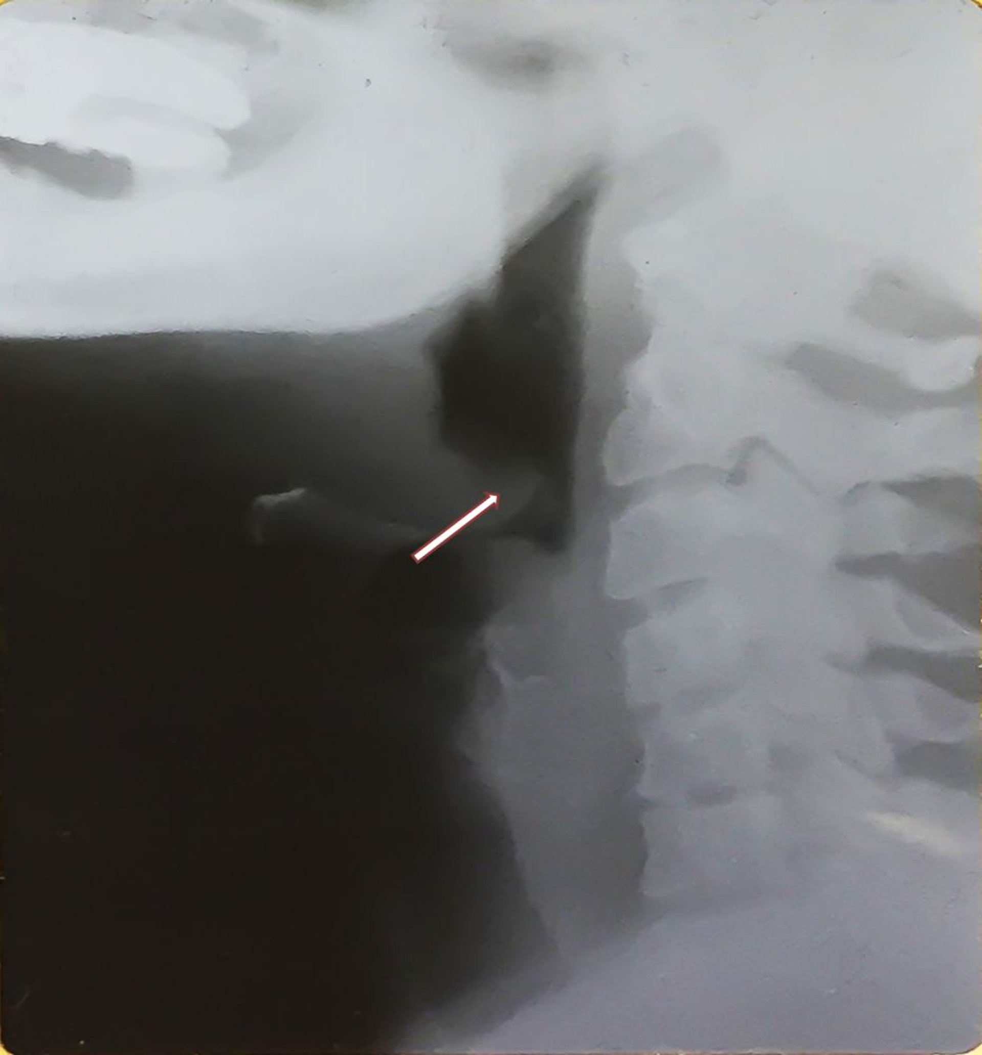 Epiglotitis (adulto)