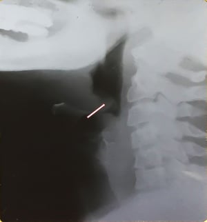 Epiglotitis (adulto)