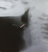 喉頭蓋炎（成人）