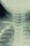 声門下クループ（Subglottic Croup）