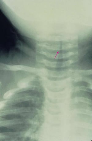 声門下クループ（Subglottic Croup）