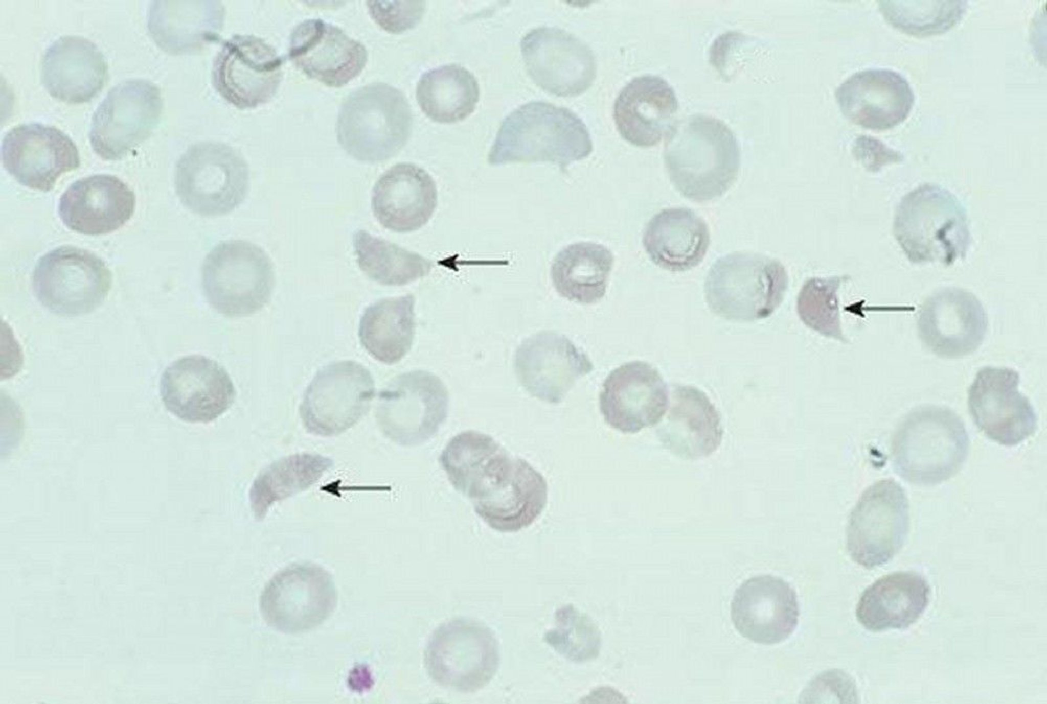 Schistocytes (Red Blood Cell Fragments)