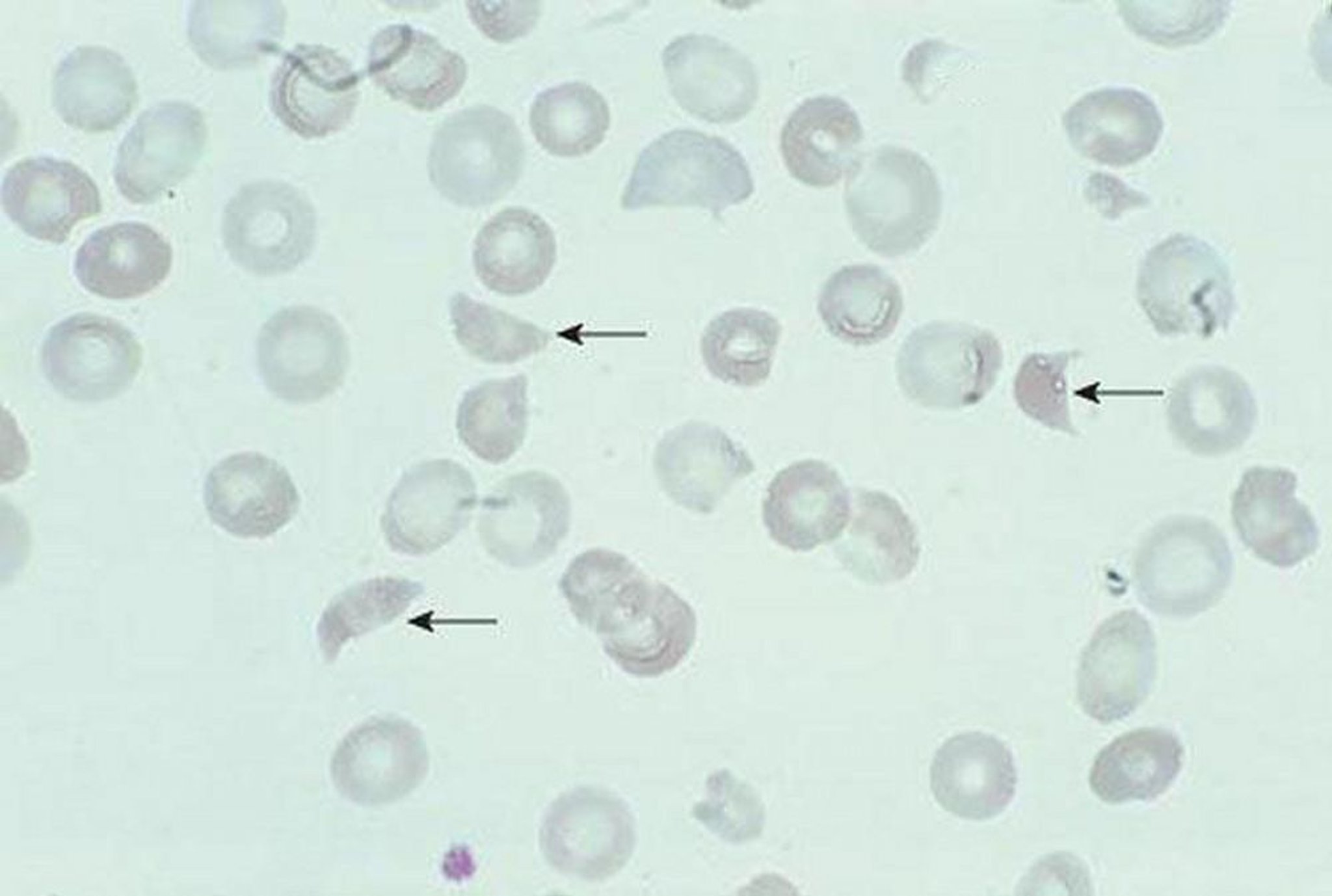 Esquistocitos (fragmentos de eritrocitos)