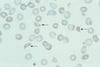 Schistocytes (fragments de globules rouges)