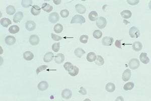 Schistocytes (fragments de globules rouges)