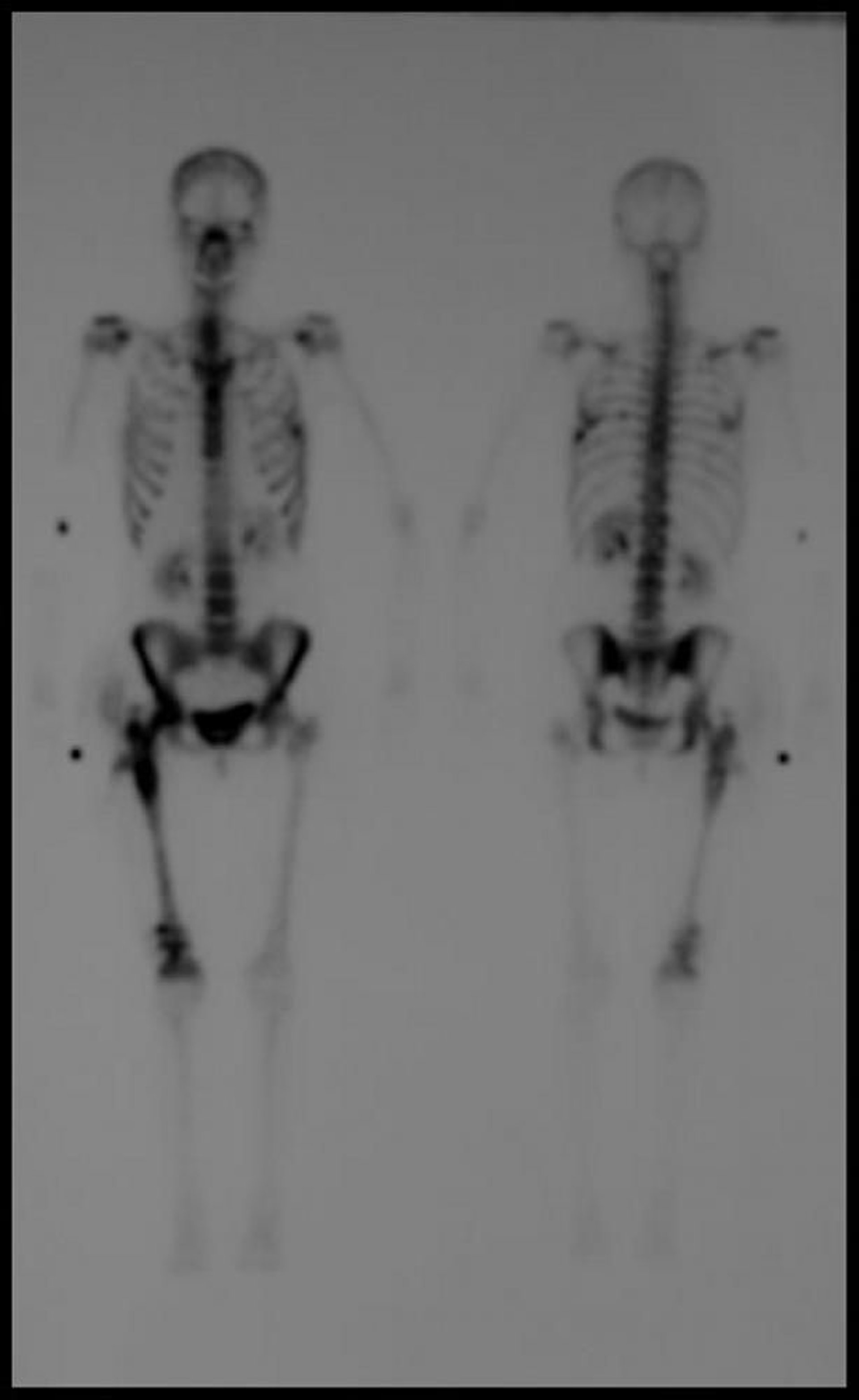 Centellografía ósea del cuerpo entero