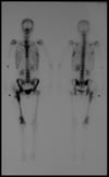 Bone Scintigraphy of the Whole Body