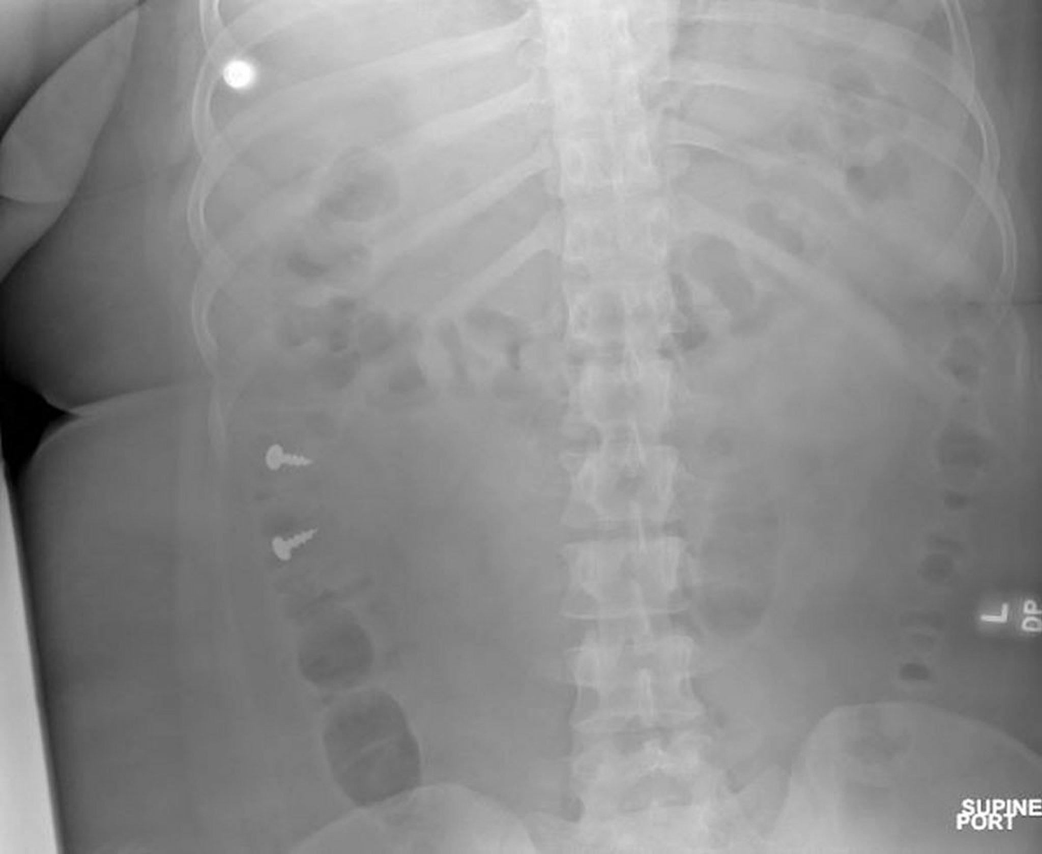 Tornillos en el colon (radiografía)