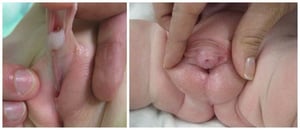 Hypospadias scrotal