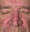 Seborrheic Dermatitis