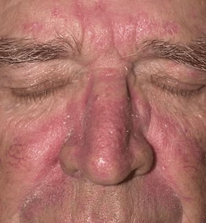 Dermatitis seborreica
