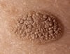 Queratosis seborreica