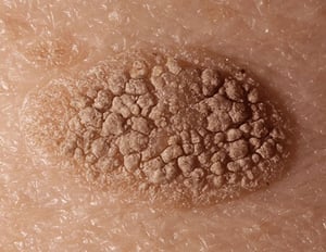 Queratosis seborreica