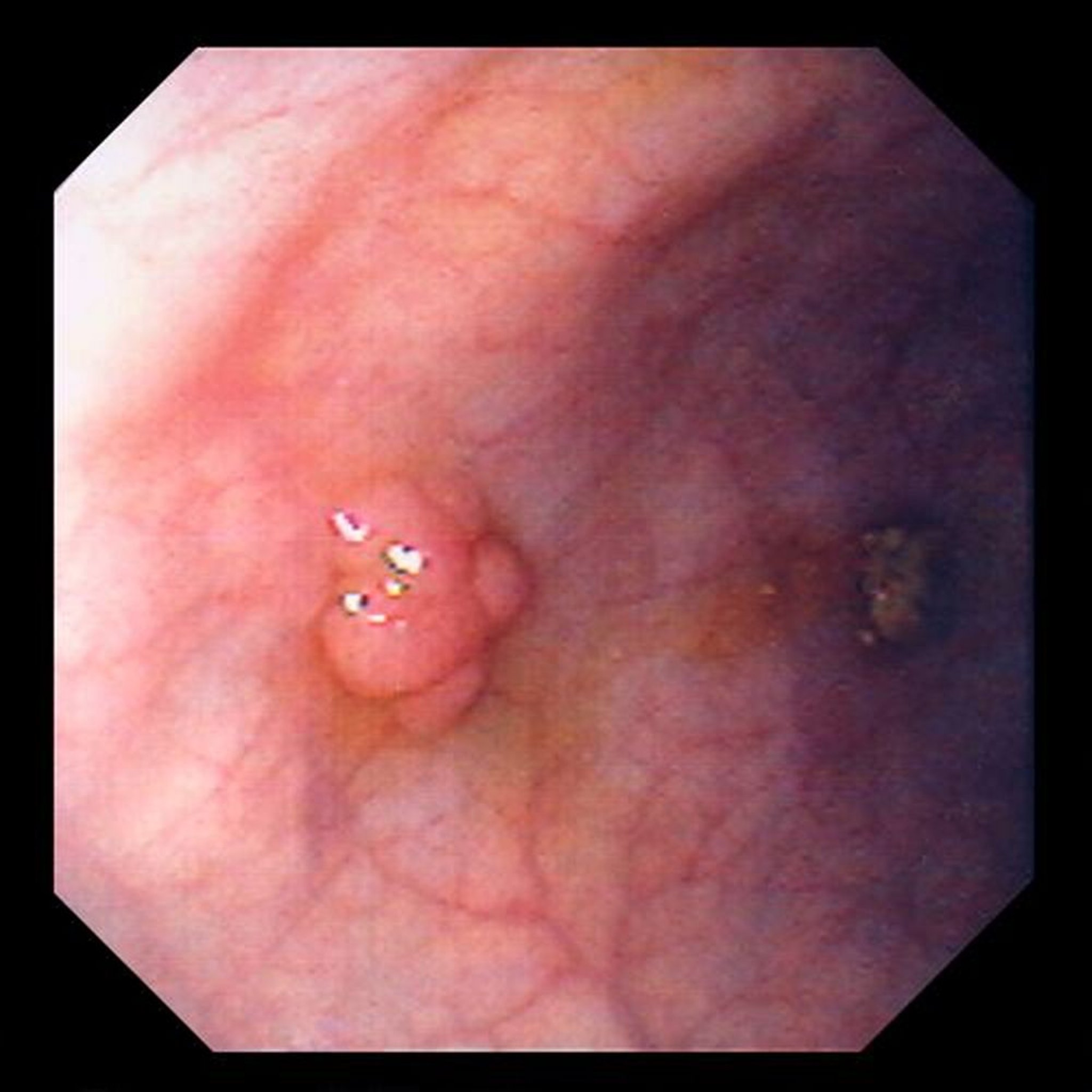 Sessiler Polyp