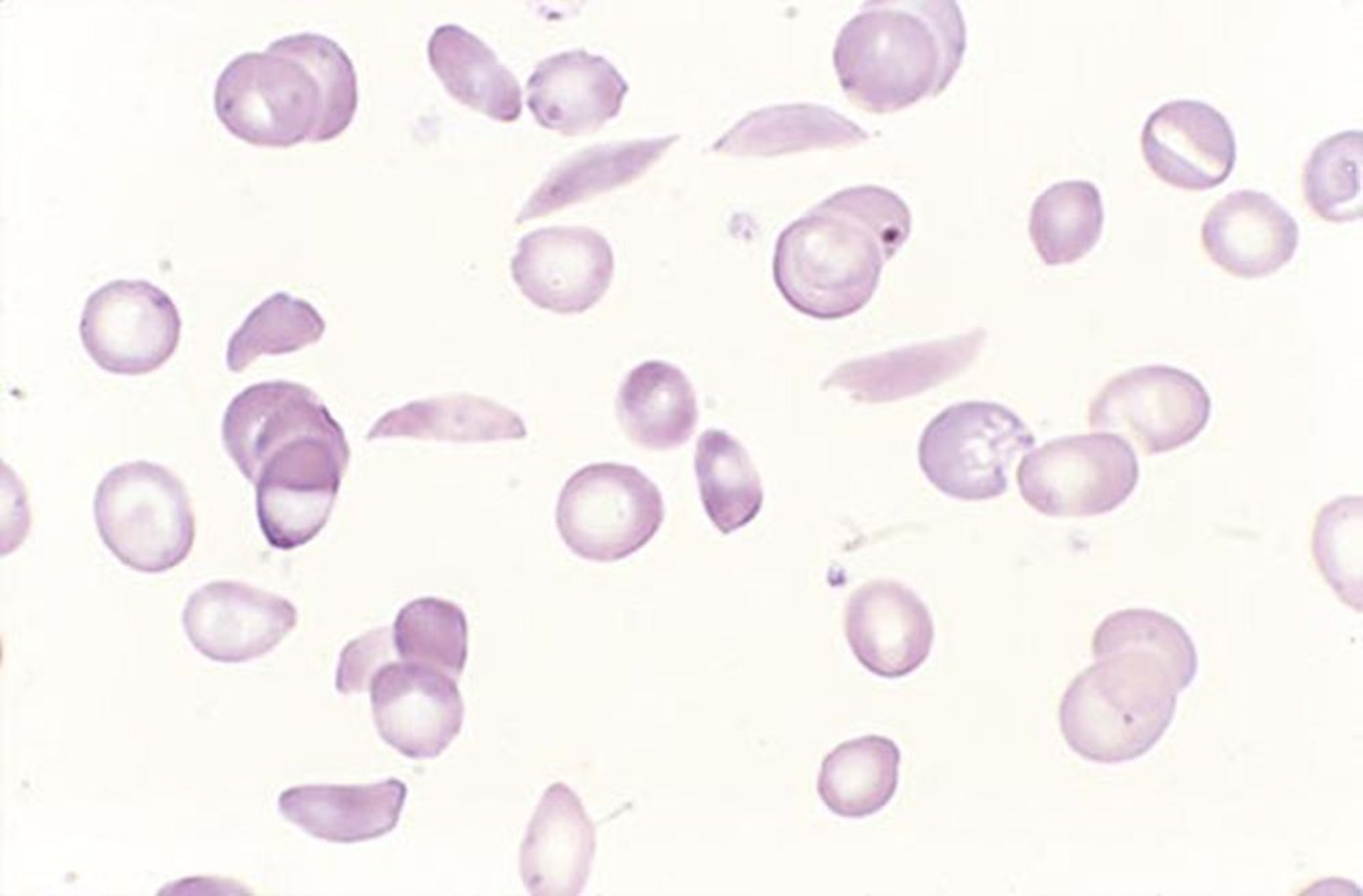 Cellule falciformi