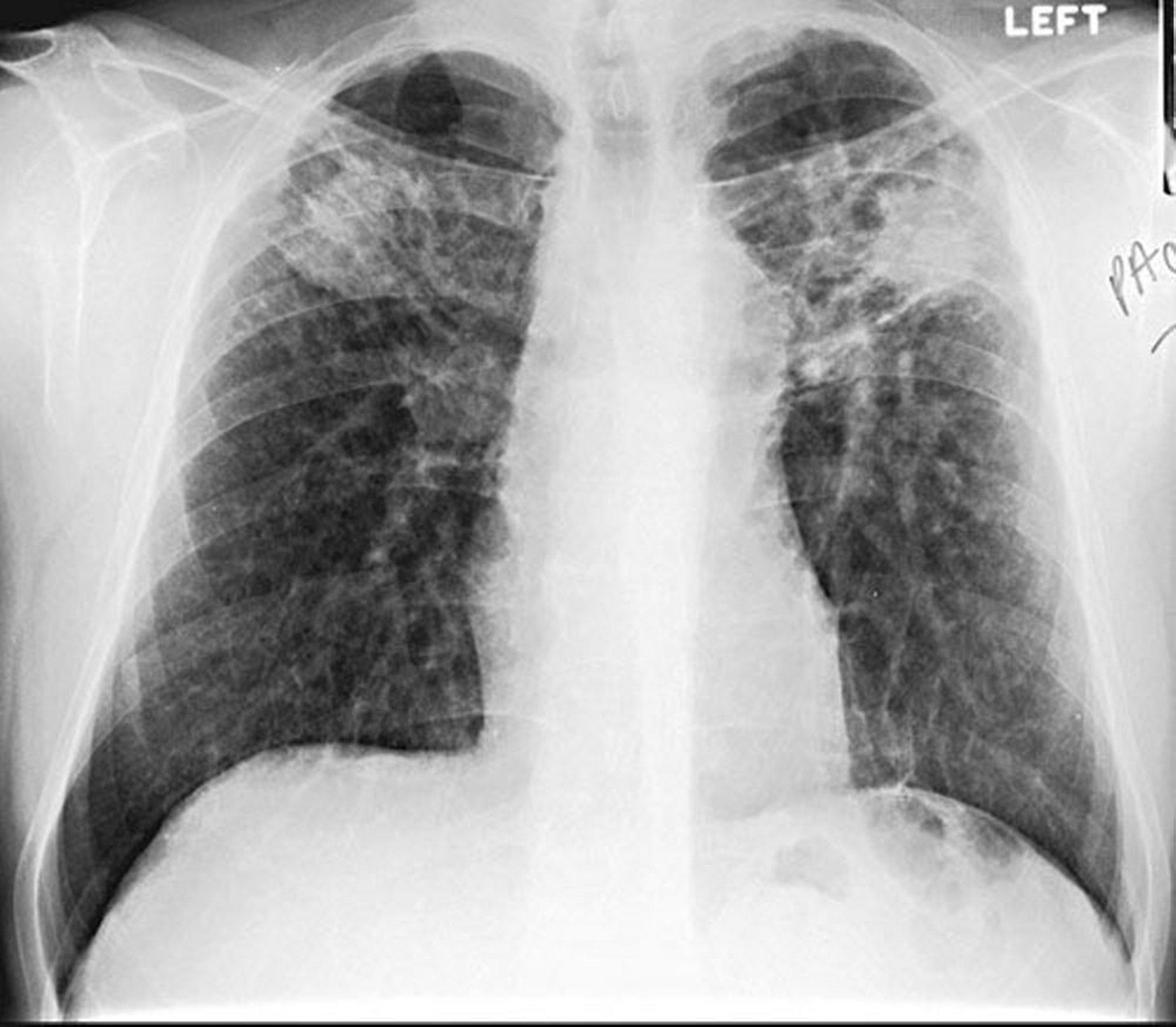 Bệnh bụi phổi – Thể kết khối