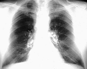 Silicose, calcifications en coquille d'œuf