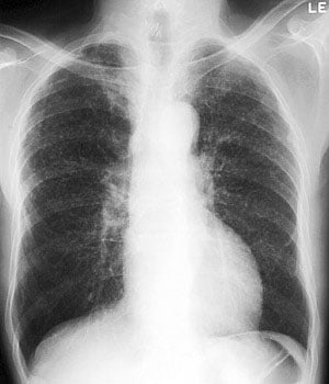 珪肺症—単純性