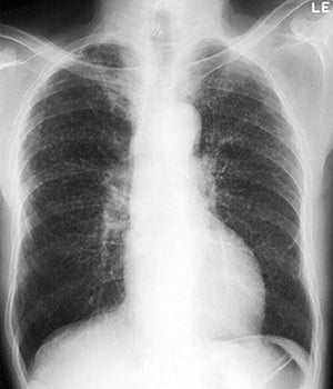 Bệnh bụi phổi silic—Thể đơn thuần